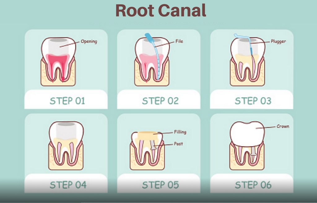 Root Canal Treatment in chennai 
