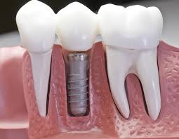 I. Dental Implants (1)