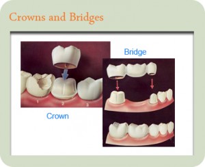 dental crowns and bridge