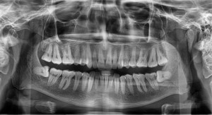 Full Mouth X-rays