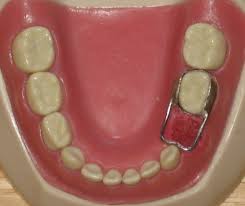Teeth Space Maintaining